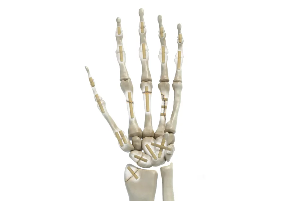Shark Screw Indication - Arthrodesen mit Shark Screw