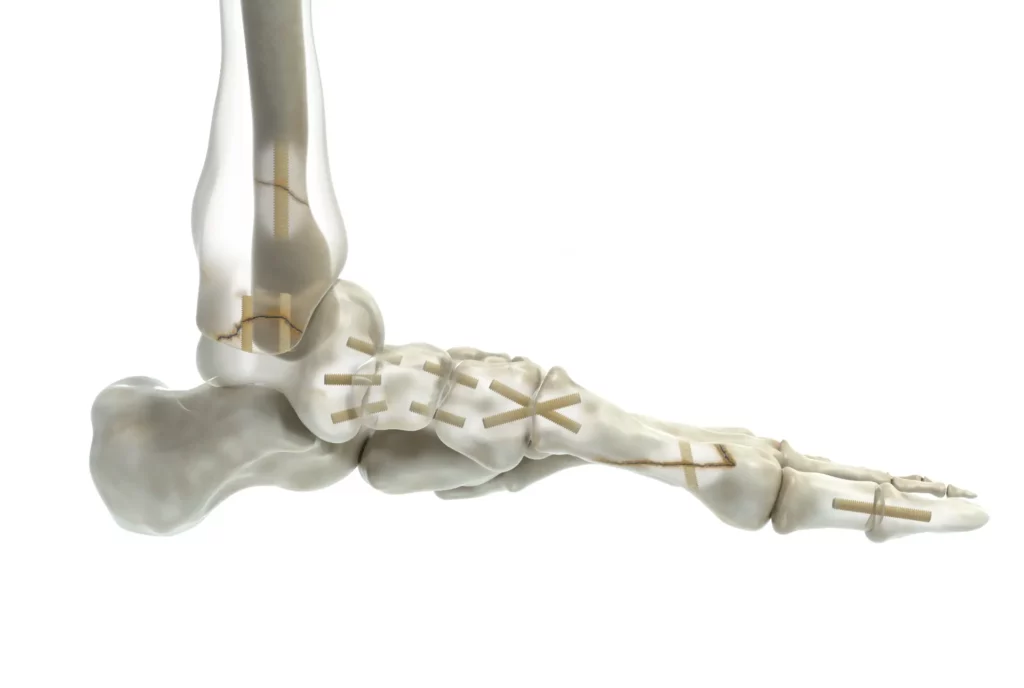 Shark Screw Indication - Arthrodesen mit Shark Screw