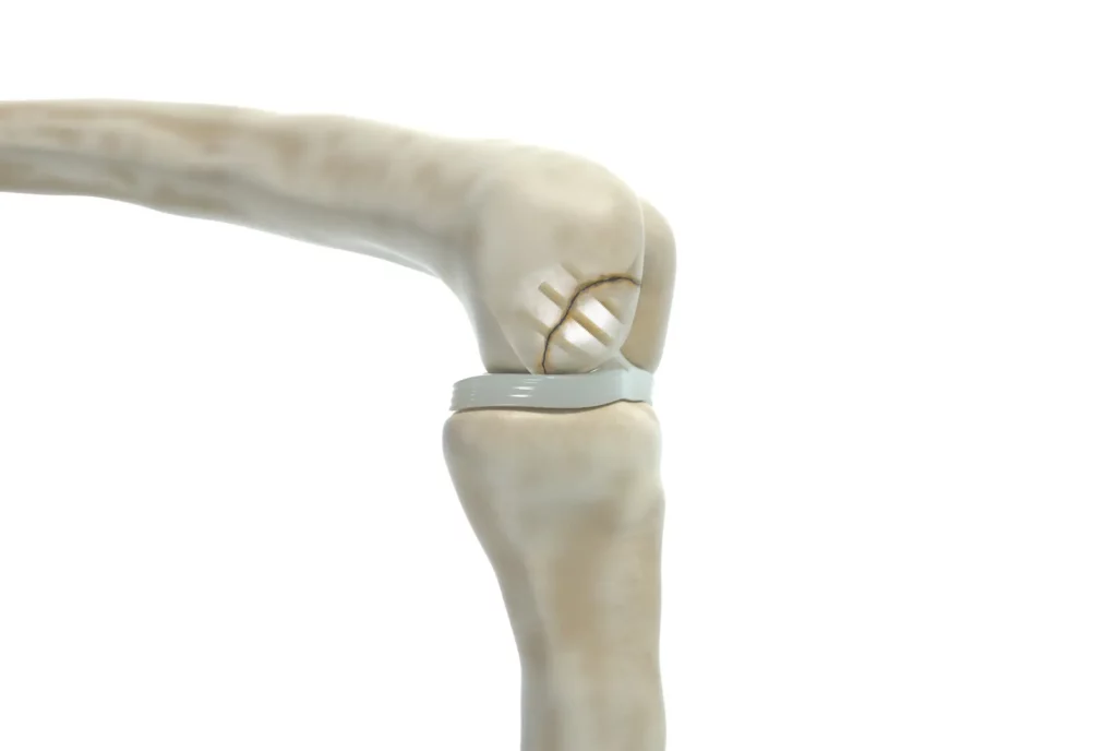 Shark Screw Indication - Arthrodesen mit Shark Screw