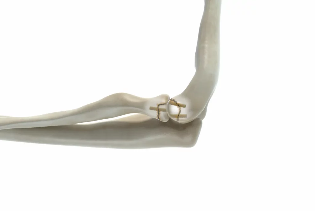 Shark Screw Indication - Arthrodesen mit Shark Screw
