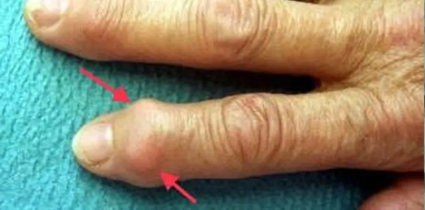 Fingergelenksarthrosen - Arthrosen