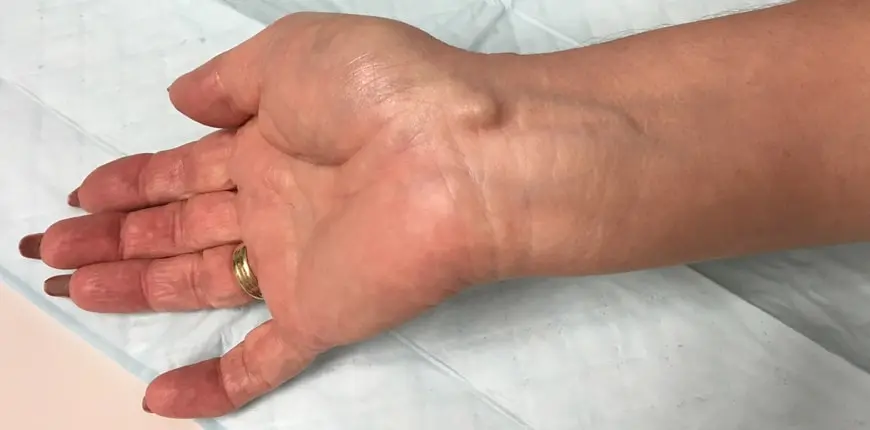 Ganglion - Ganglien und Tumore an der Hand