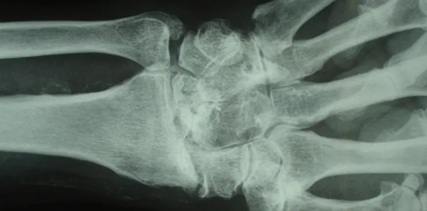 Handgelenksarthrose - Arthrosen