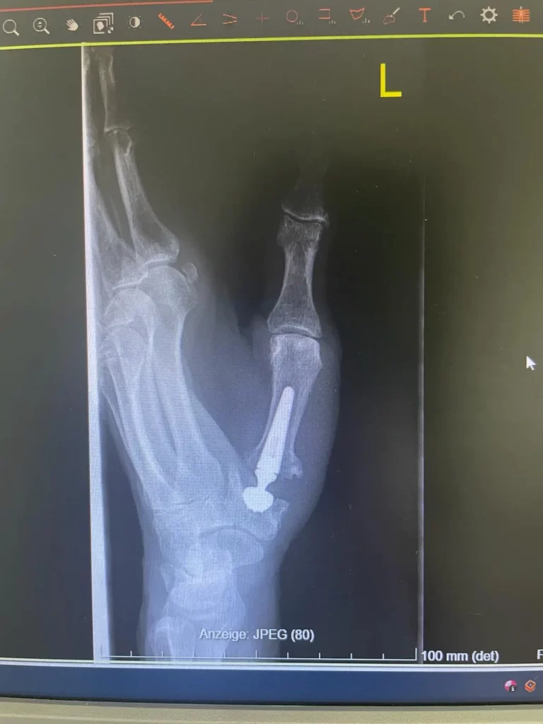 Arthrosen - Arthrosen
