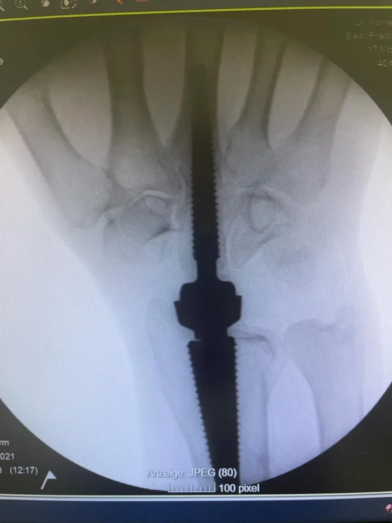 Arthrosen - Arthrosen